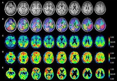 [18F]FDG, [11C]PiB, and [18F]AV-1451 PET Imaging of Neurodegeneration in Two Subjects With a History of Repetitive Trauma and Cognitive Decline